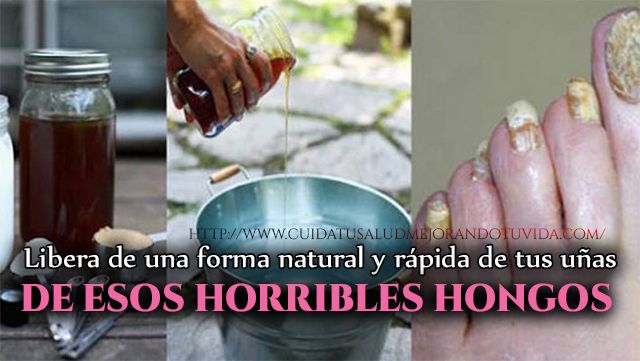 Desaparece de una vez esas infecciones fungicidas en tus uñas