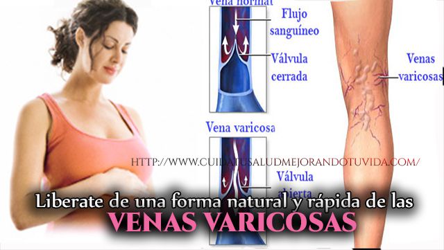 Cómo tratar las venas varicosas durante el embarazo?